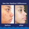 PanOxyl Acne Foaming Wash for Face & Body 156gm Benzoyl Peroxide 10% Maximum Strength Antimicrobial